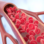 Study Examines Myositis-Specific Autoantibody in Idiopathic Inflammatory Myopathy