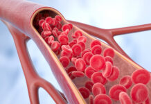 Study Examines Myositis-Specific Autoantibody in Idiopathic Inflammatory Myopathy