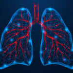 Brensocatib Effectiveness Similar for Bronchiectasis With and Without Eosinophilia